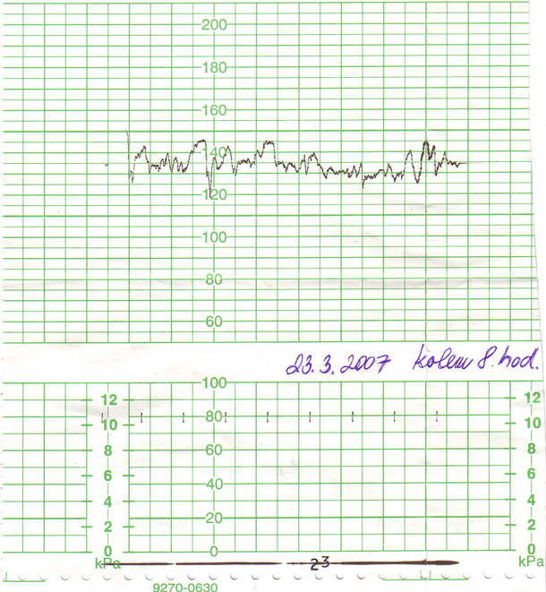 kratik zznam srdka cca 3 hod ped porodem