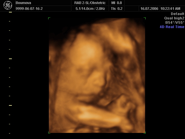 1 foto z ultrazvuku