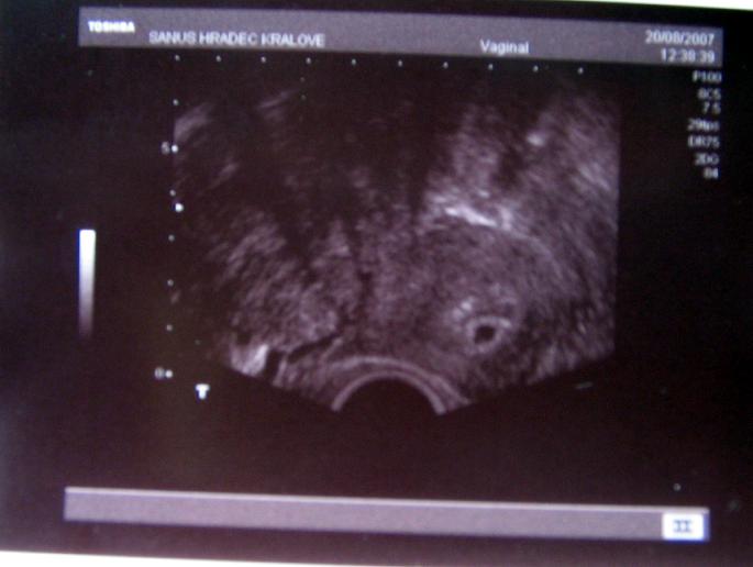 Hafb prvn ultrazvuk